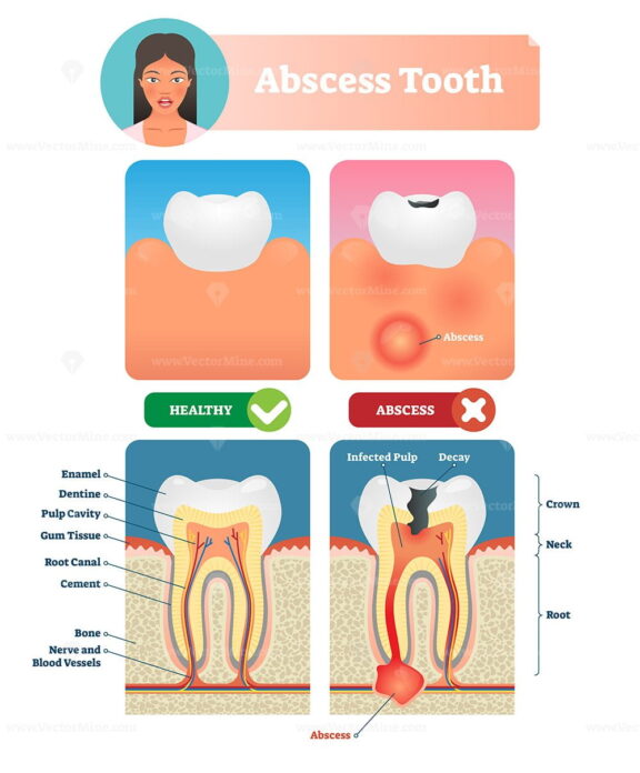 Abscess tooth vector illustration