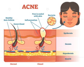Acne skin layer diagram illustration
