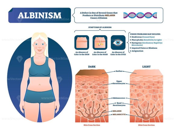 Albinism vector illustration