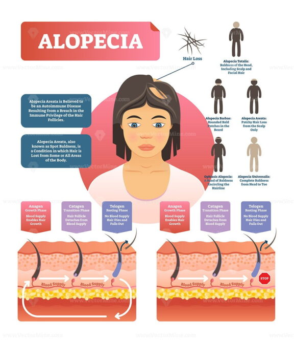 Alopecia vector illustration