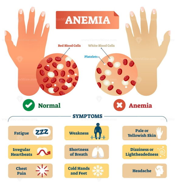 Anemia vector illustration