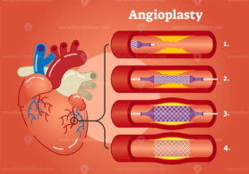 Illustrated scheme showing Angioplasty concept in 4 steps
