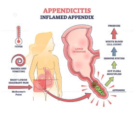 Appendicitis, inflamed appendix, abdominal problem diagnosis outline diagram