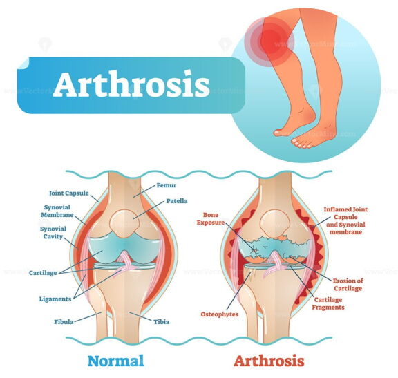 Arthrosis medical vector illustration diagram with damaged knee structure and healthy knee comparison