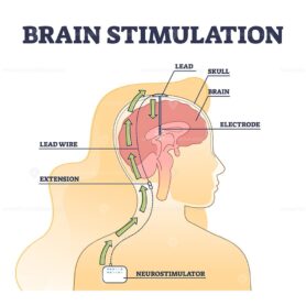 Deep brain stimulation procedure educational explanation outline diagram