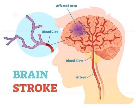 Brain stroke anatomical vector illustration