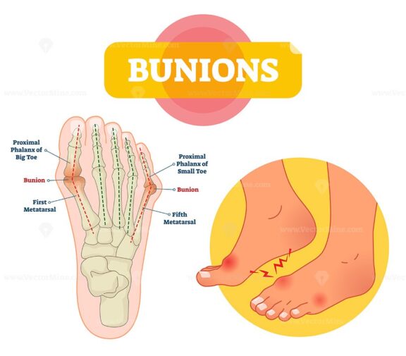 Bunions vector illustration