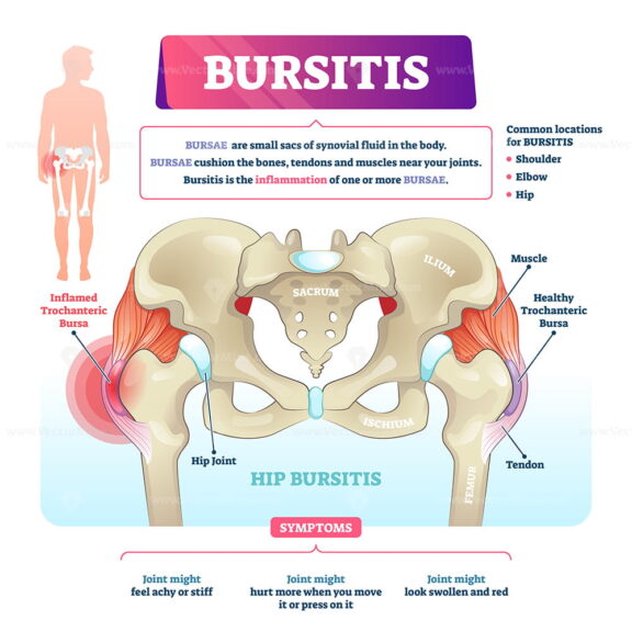 Bursitis vector illustration