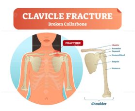 Clavicle fracture with broken collarbone vector illustration