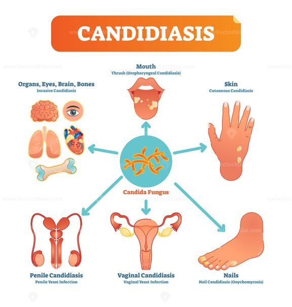 Candidiasis medical vector illustration diagram poster with all types of candida fungus on various human body parts and organs