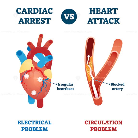 Cardiac arrest vs heart attack vector illustration