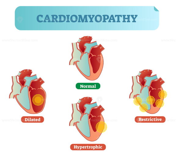 Cardiomyopathy medical disorders cross section diagram, vector illustration examples with normal, dilated, hypertrophic and restrictive conditions