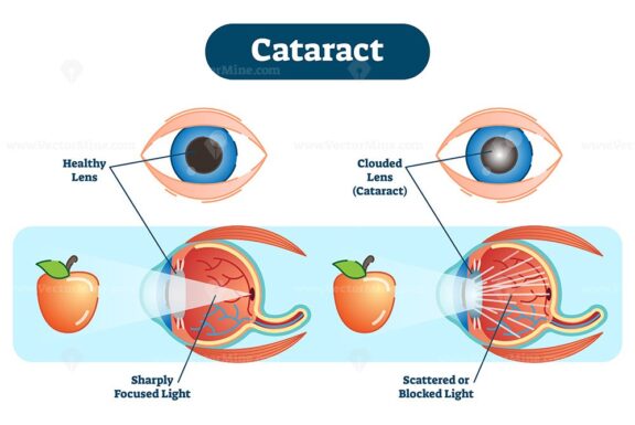 Cataract vector illustration diagram, anatomical scheme
