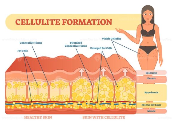 Cellulite formation vector illustration diagram