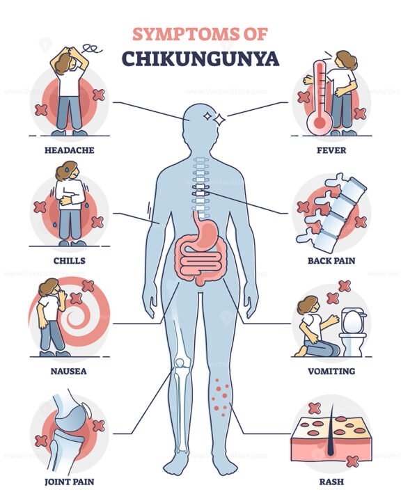 Chikungunya fever symptoms awareness, educational vector illustration diagram