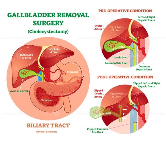Cholecystectomy - Gallbladder removal surgery, anatomical vector illustration diagram