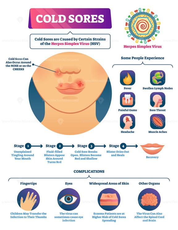 Cold sores vector illustration