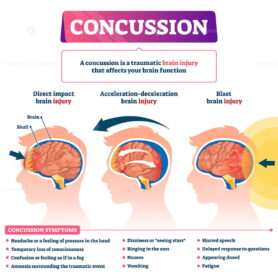 Concussion vector illustration