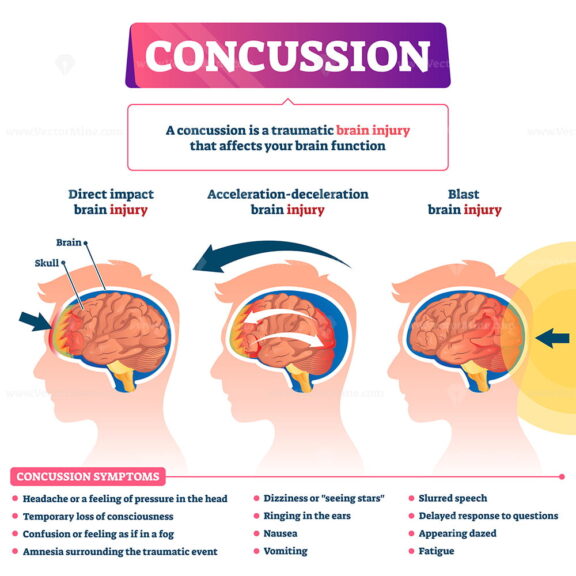 Concussion vector illustration