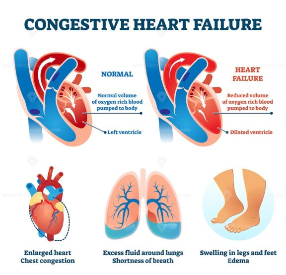 Congestive heart failure vector illustration