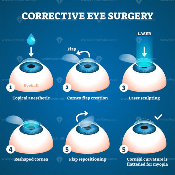 Corrective eye surgery vector illustration