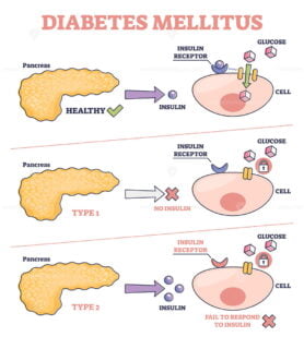 Diabetes mellitus as high blood sugar and metabolic illness outline diagram