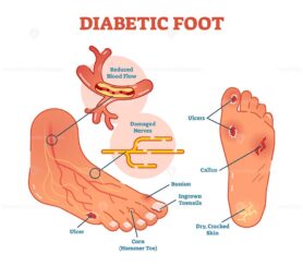 Diabetic foot medical vector illustration