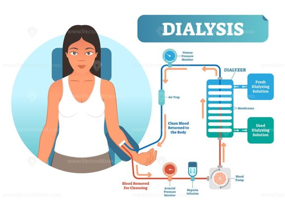 Dialysis medical procedure system vector illustration diagram