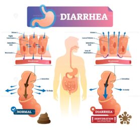 Diarrhea vector illustration