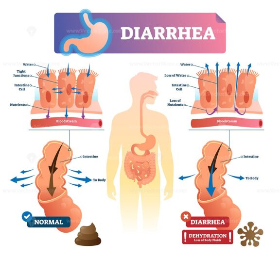 Diarrhea vector illustration