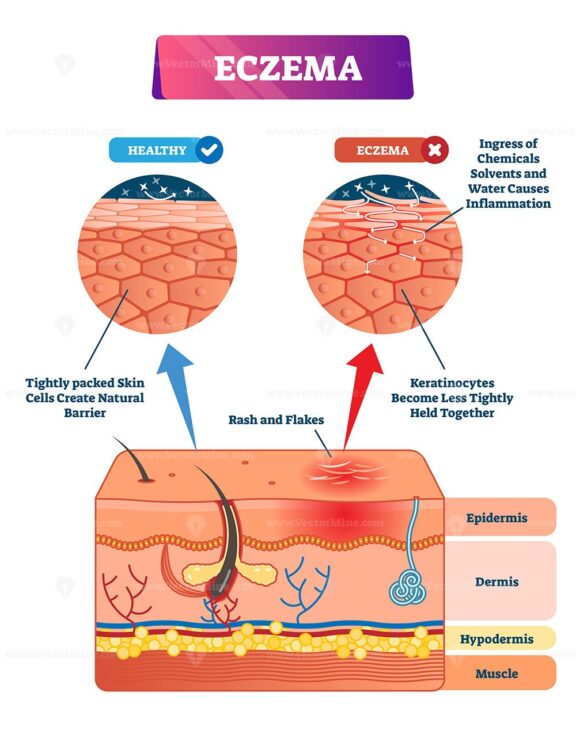 Eczema vector illustration