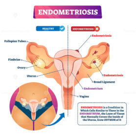 Endometriosis vector illustration