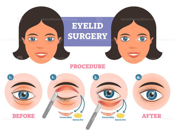 Eyelid surgery procedure before and after illuatration