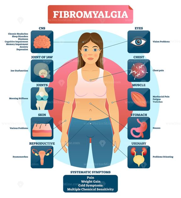 Fibromyalgia vector illustration