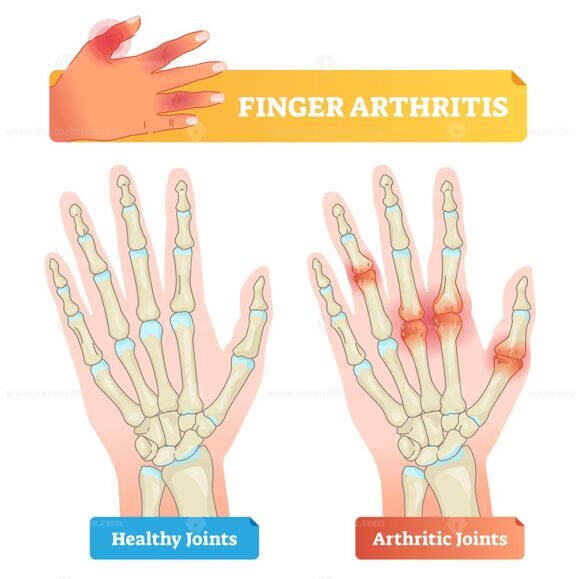 Finger arthritis vector illustration