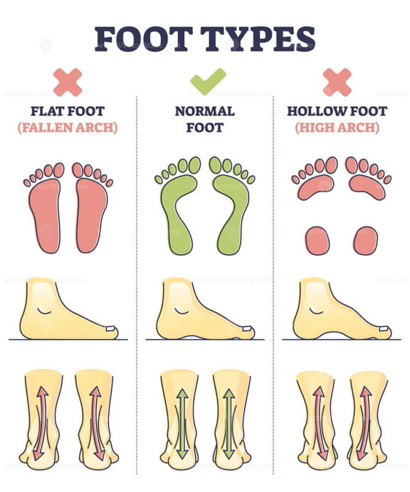 Foot types with flat, normal and hollow feet comparison in outline diagram
