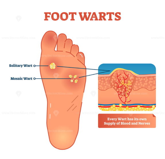 Foot warts vector illustration