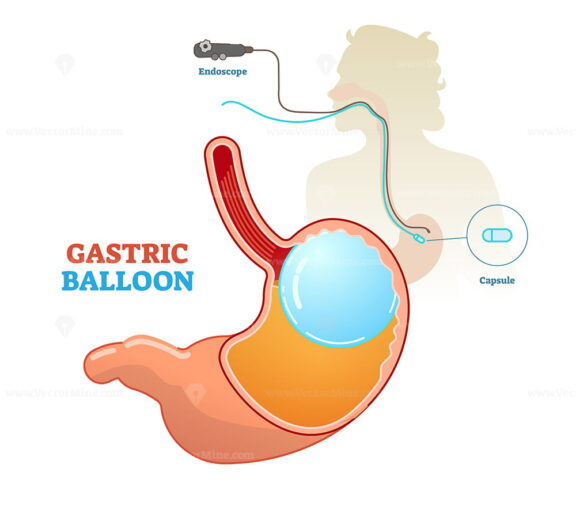 Gastric balloon medical procedure concept diagram
