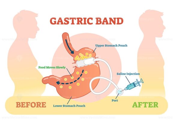 Gastric band anatomical vector illustration diagram