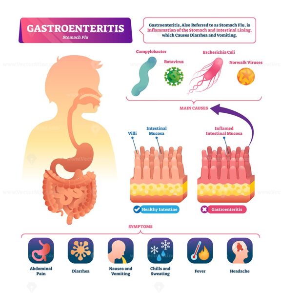 Gastroenteritis vector illustration