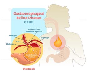 Gastroesophageal reflux disease diagram scheme