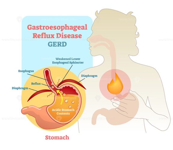 Gastroesophageal reflux disease diagram scheme