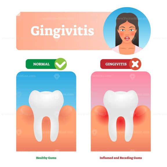Gingivitis vector illustration