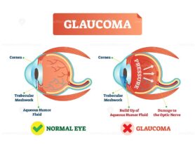 Vector illustration of glaucoma illness