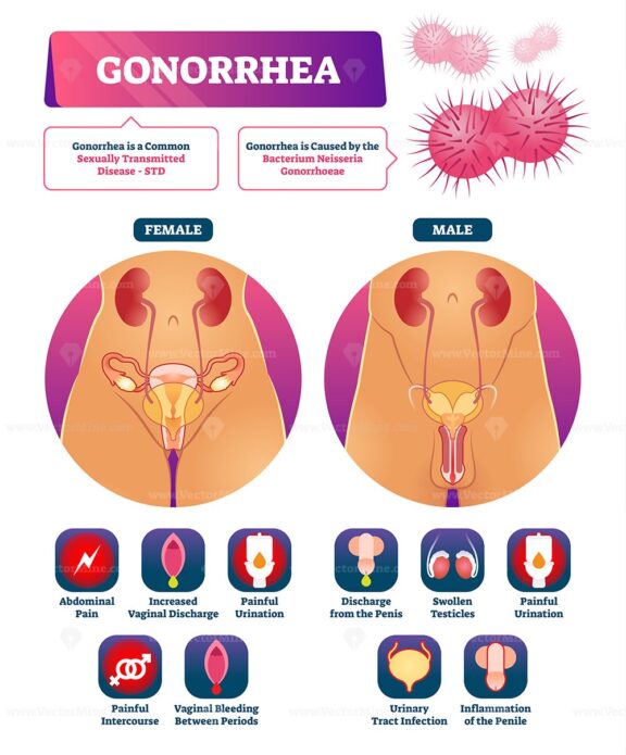 Gonorrhea vector illustration