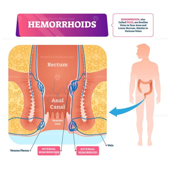 Hemorrhoids vector illustration