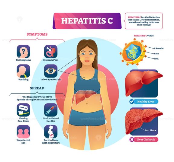 Hepatitis C vector illustration