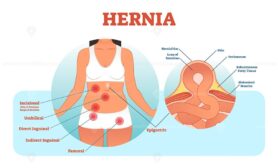 Hernia types vector illustration and cross section of muscle rupture and intestine