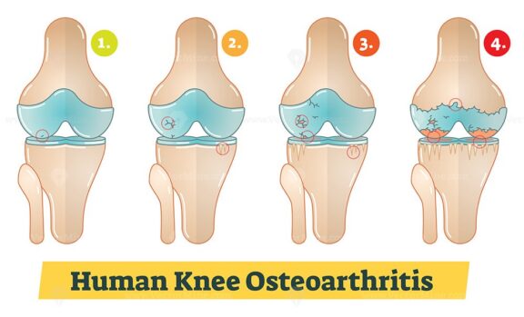 ribbos_frames_1Human Knee Osteoarthritis vector diagram illustration