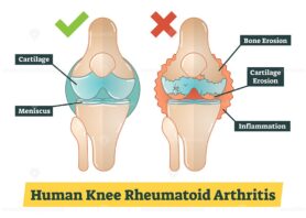 Human Knee Rheumatoid Arthritis vector diagram illustration